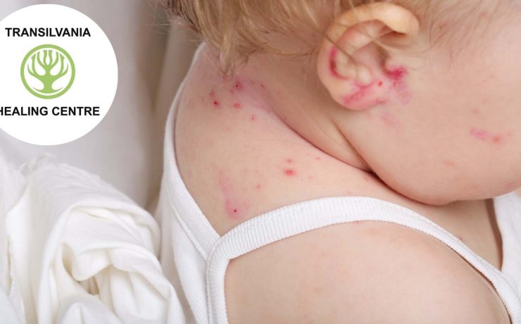Metode inovatoare de combatere a Dermatitei atopică la copii 1 atopica Combaterea Dermatitei Atopice la Micuții Noștri - Sfaturi și Tratamente Eficiente